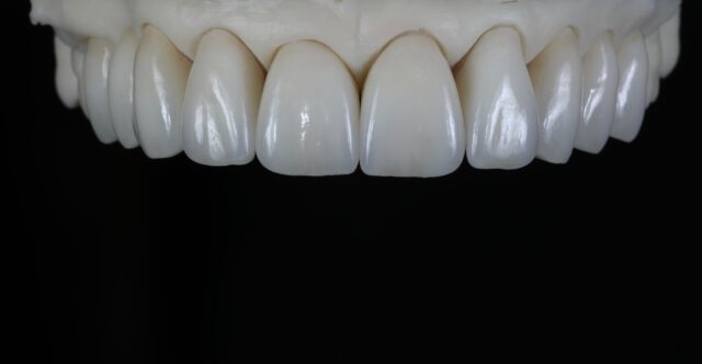 Helaas hebben we niet van al onze werkstukken foto’s van het eindresultaat in de mond. En eerlijk is eerlijk: sommige casussen zijn op het model al zó mooi dat ze het delen meer dan waard zijn.
Deze case laat dat goed zien. Tien delen, volledig opgebakken op lithium.