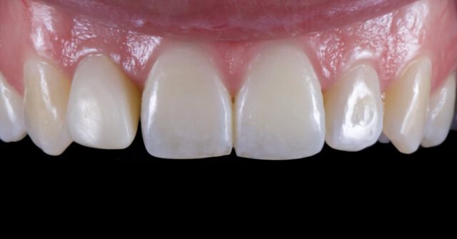 Pareltje! 💥Deze kroon op implantaat hebben we individueel afgebakken en samen met de patiënt in het lab afgemaakt. Voorzien van hoog gepolijst zirconium onder het tandvlees en een geanodiseerde titanium basis.

Implantaat: Megagen
Zirconium: Zirconzahn
Porselein: Emax Ceram