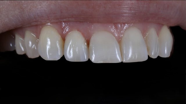 Vandaag laten we een facing van lithiumdisilicaat zien, opgebakken met keramiek. Deze is overkapt uitgevoerd om de kans op chipping te minimaliseren.

Lithiumdisilicaat: e.max Press
Keramiek: e.max Ceram