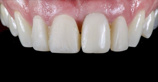 Weer een mooi werkstuk op lithium. Drie facings en één kroon op een individueel zirconium abutment. Opgebakken keramiek op een lithium onderstructuur. Alles individueel afgebakken samen met de patiënt.

Lithium: Emax press
Zirconium: Zirkonzahn
keramiek: Emax ceram
implantaat: Megagen