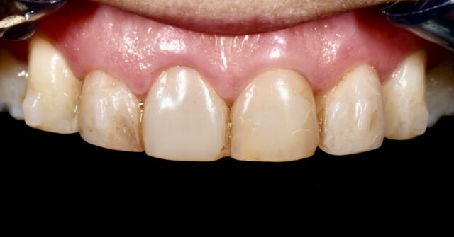 4 opgebakken lithium facings, individueel afgebakken voor een maximaal esthetisch resultaat.

Lithium: emax press
Keramiek: emax ceram