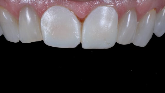 Twee prachtige opgebakken lithium facings met minimale dikte. Zoals bij vrijwel al onze esthetische casussen zijn ook deze samen met de patiënt tijdens een afbaksessie tot in detail afgewerkt voor het beste resultaat.

Lithium: e.max Press
Porselein: e.max Ceram
