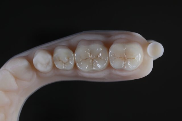 3 anatomische inlays van lithiumdisilicaat. Digitaal ontworpen, in was gefreesd en vervolgens geperst voor een optimale pasvorm en maximale sterkte. Natuurlijk gestaind en afgewerkt voor een zo esthetisch en natuurlijk mogelijk eindresultaat.

was: Zirkonzahn
Lithium: Emax press
stain: Emax ceram art