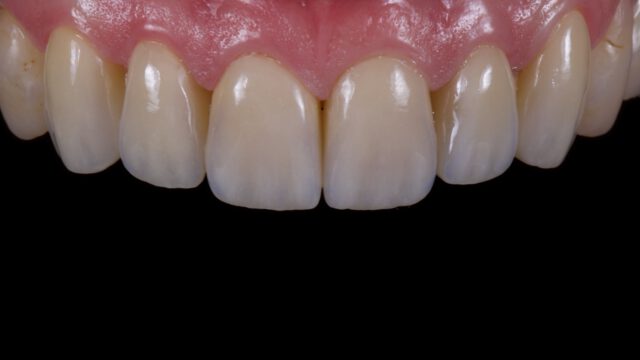 4 prachtige opgebakken kronen op lithiumdisilicaat. Met zorg gelaagd voor een levendig en natuurlijk resultaat. De laatste details hebben we samen met de patiënt aan de stoel verfijnd, zodat vorm, kleur en karakter perfect aansluiten.

lithium: Emax press
porselein: Emax ceram
stain: Emax essence