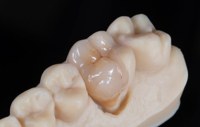Soms zit alles mee en ontstaat er een werkstuk dat bijna perfect is. De kleur, morfologie en pasvorm zijn precies zoals we het graag zien.
En let vooral op de knobbel van Carabelli. Deze was ook aanwezig op de 16 en hebben we mooi terug laten komen in het werkstuk.
Lithium: Emax press
Stain: Emax ceram Art