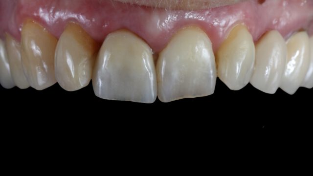 Vandaag een mooie, doorleefde tand mogen maken. 🦷
Opgebouwd op zirconium en samen met de patiënt aan de stoel afgebakken.
Zirkonium: Prettau dispersive
Porselein: emax ceram
Stain: Emax art